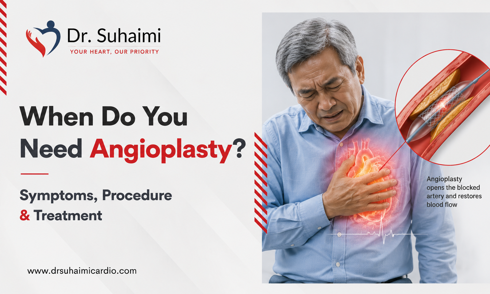 When Do You Need Angioplasty? Symptoms, Procedure & Treatment in Malaysia